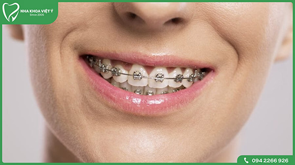 Phương pháp niềng răng chỉnh nha là gì?