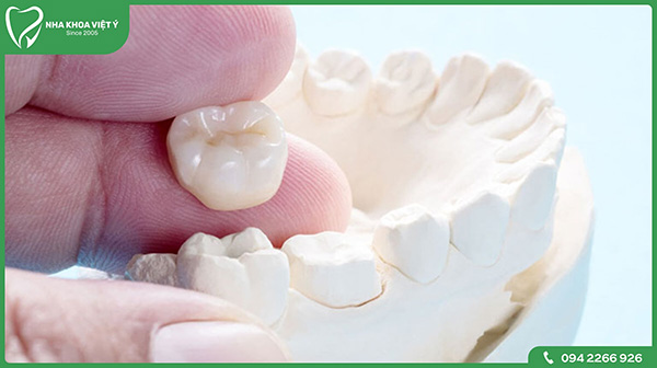 Loại răng sứ thích hợp cho bọc răng sứ 1 chiếc