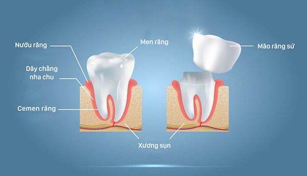 Phương pháp bọc răng sứ là gì?