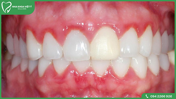 Bọc răng sứ bị viêm lợi có nguy hiểm không?
