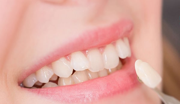 Trường hợp áp dụng phương pháp bọc răng sứ không mài răng