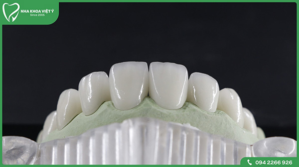 Răng sứ Zirconia có tuổi thọ cao 