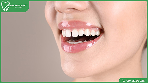 Bọc sứ răng cửa áp dụng cho trường hợp nào?