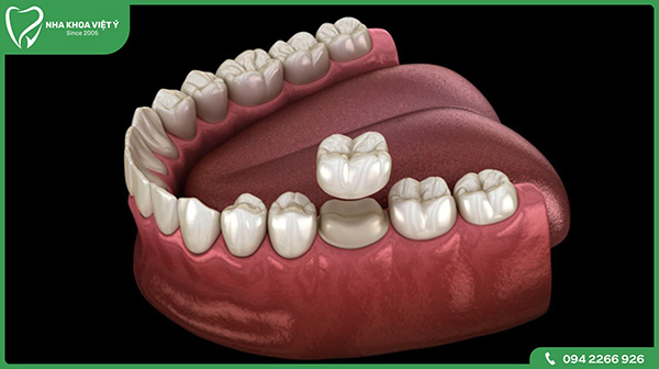 Đôi nét về phương pháp bọc sứ răng hàm