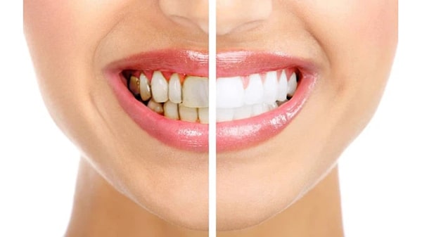 Cạo vôi răng có trắng răng không?