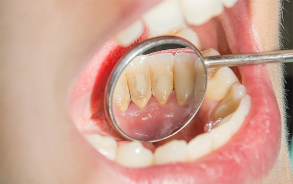 Cao răng là gì? Tại sao phải cạo vôi răng?