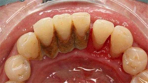 Tình trạng cao răng