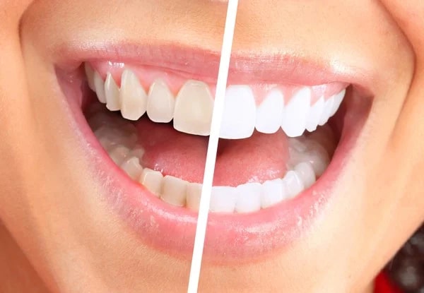 Lợi ích giúp răng trở nên trắng sáng hơn