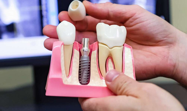 Làm răng Implant có ưu nhược điểm gì?
