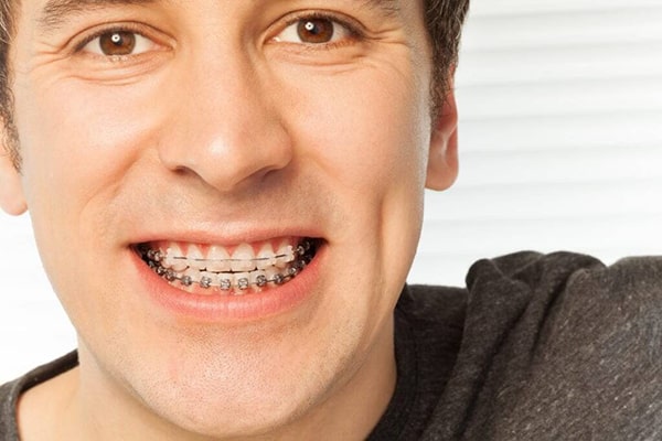 Niềng răng ở người lớn có hiệu quả không?