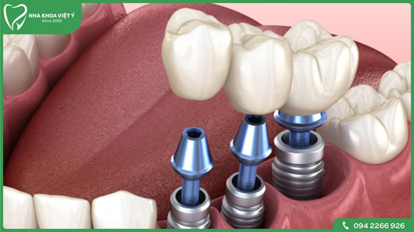 Tổng quan về phương pháp trồng răng Implant