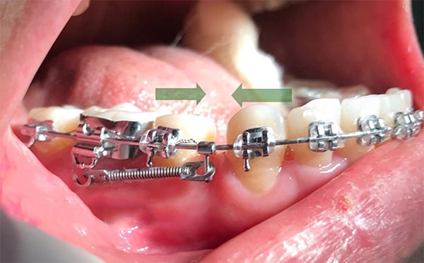 Giai đoạn đóng khoảng trong niềng răng diễn ra như thế nào?