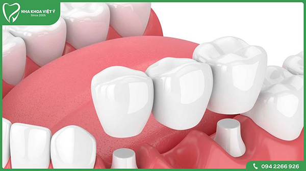 Trồng răng bằng cầu răng sứ là gì?
