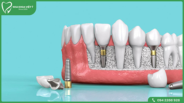 Người bị mất răng nên trồng răng sứ hay Implant?