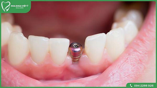 Mất răng có cần trồng lại bằng Implant không?