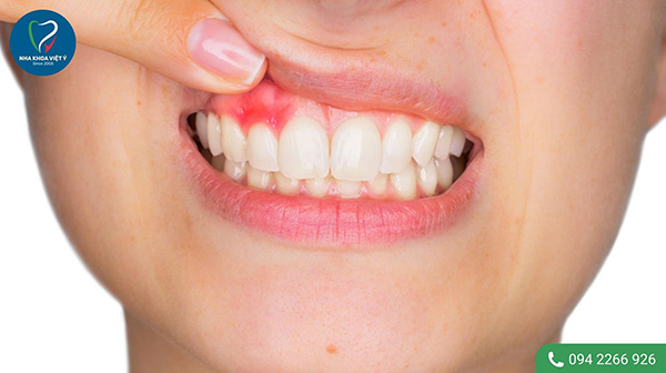 Răng khôn mọc lệch có thể gây ra những biến chứng gì?
