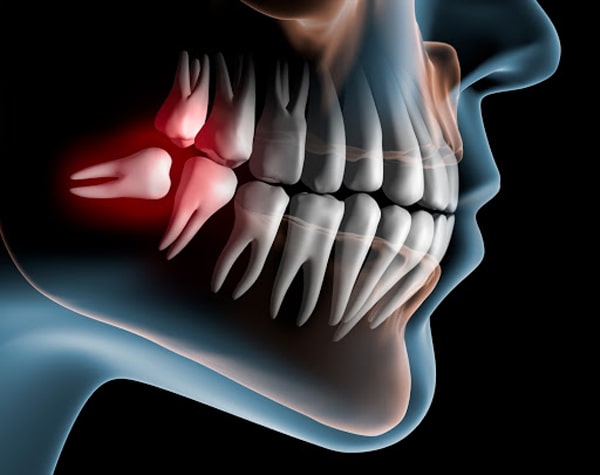 Nhổ răng khôn mọc ngầm có đau không?