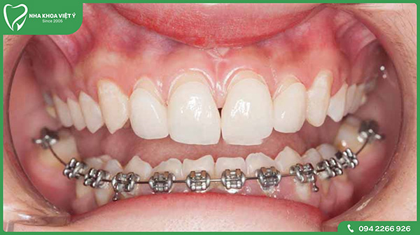 Niềng răng 1 hàm có được không và đối tượng nên sử dụng