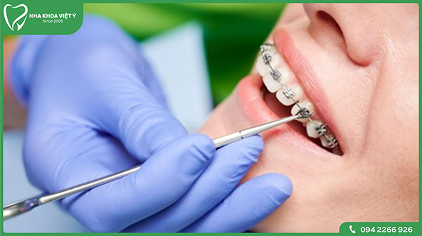 Quy trình niềng răng 1 hàm tiêu chuẩn thương bao gồm các bước sau: