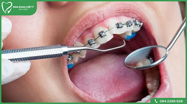 Quy trình siết răng khi niềng với 3 bước