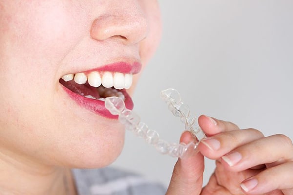 Niềng răng 3D Clear là gì? Đối tượng chỉ định
