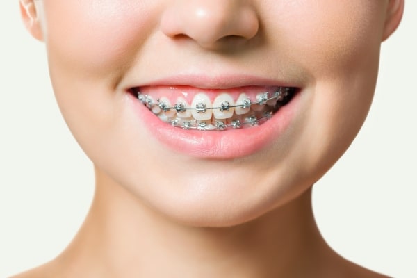 Niềng răng mắc cài kim loại là gì?