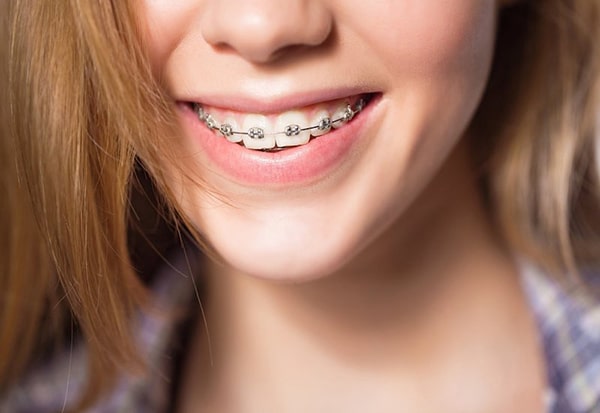 Niềng răng mắc cài kim loại có ưu điểm và nhược điểm gì?