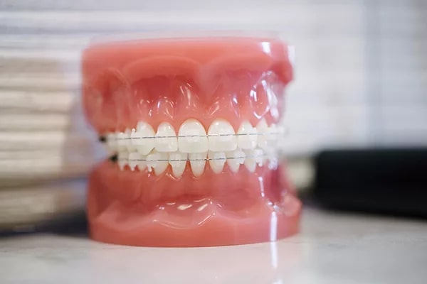Thời gian niềng răng mắc cài pha lê bao lâu?