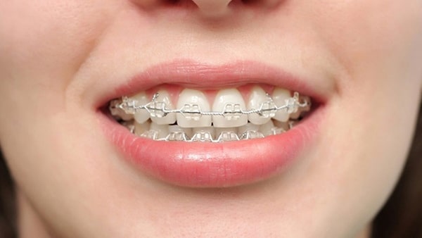Niềng răng mắc cài trong suốt bao lâu thì có hiệu quả?
