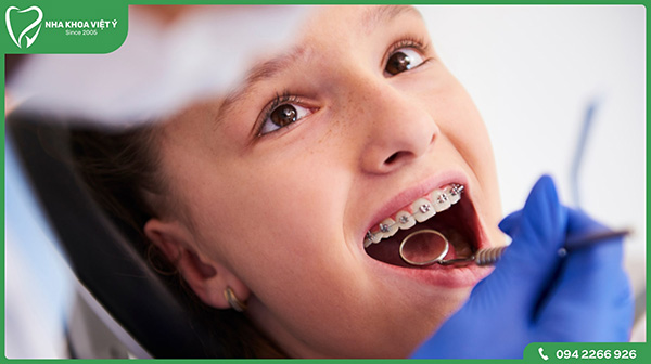 Niềng răng bao lâu thì răng bắt đầu dịch chuyển?