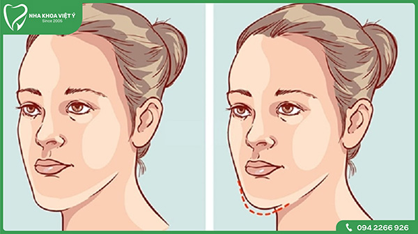 Niềng răng ảnh hưởng đến khuôn mặt như thế nào?