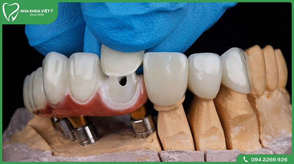 Quy trình bọc răng sứ thẩm mỹ mất bao lâu?
