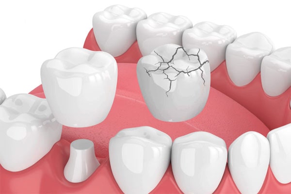 Nguyên nhân nào khiến răng bị bể, vỡ lớn?
