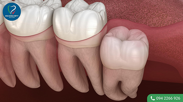Răng khôn mọc thẳng là gì?
