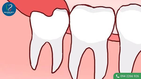 Các trường hợp răng khôn mọc thẳng không cần nhổ bỏ