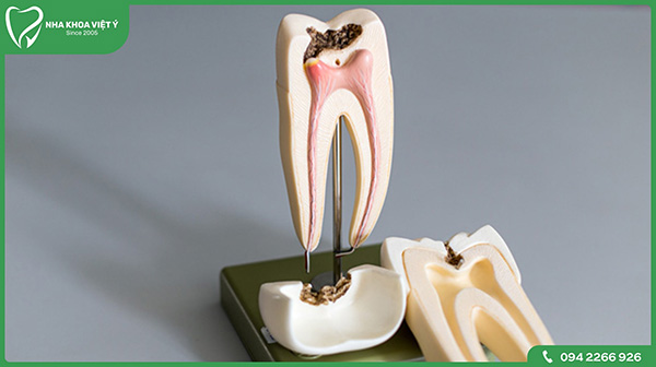 Răng lấy tủy bọc sứ được bao lâu?