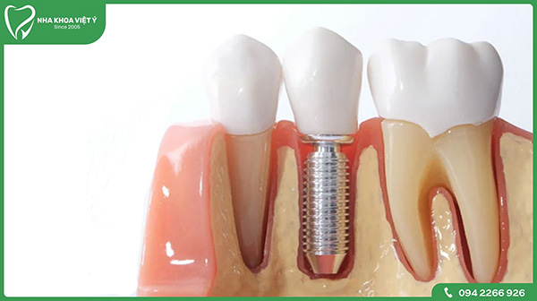 Sau khi nhổ răng bao lâu thì trồng Implant?