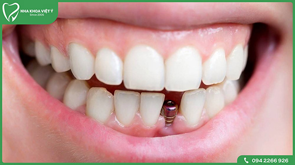 Trồng Implant trễ sau 4-12 tháng nhổ răng