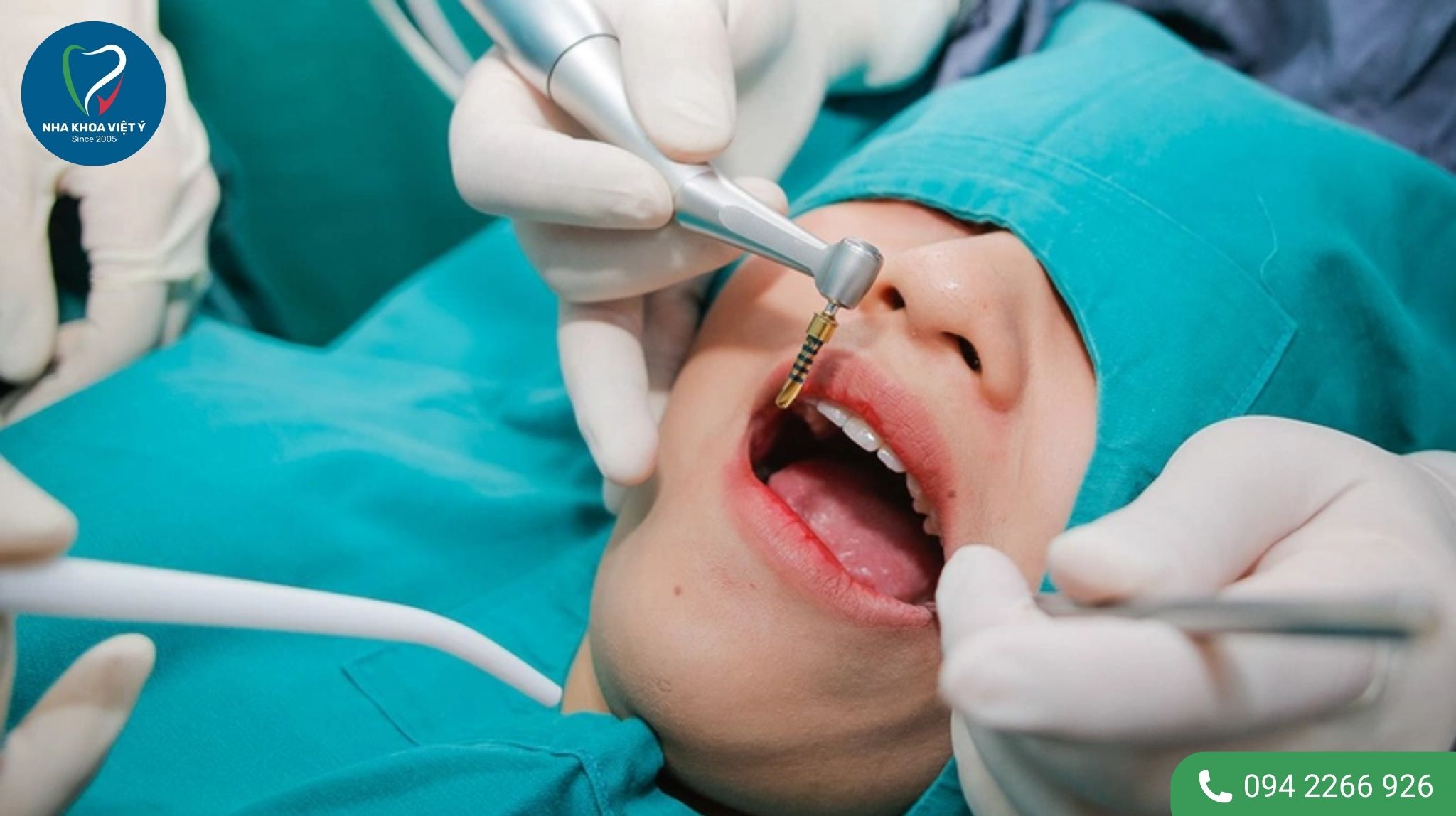 Trồng răng bằng cấy ghép Implant có thật sự tốt không?