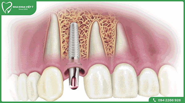 Trụ Implant không còn tích hợp với xương hàm