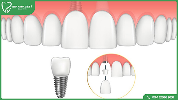 Vì sao phải trồng răng Implant răng cửa?