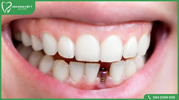 Trồng răng Implant răng cửa có an toàn không?