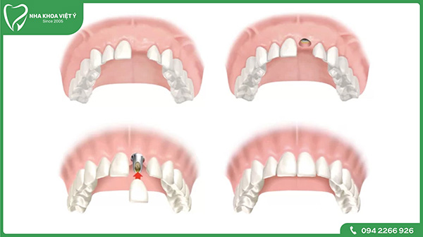 Trồng răng Implant răng cửa sẽ được thực hiện như thế nào?