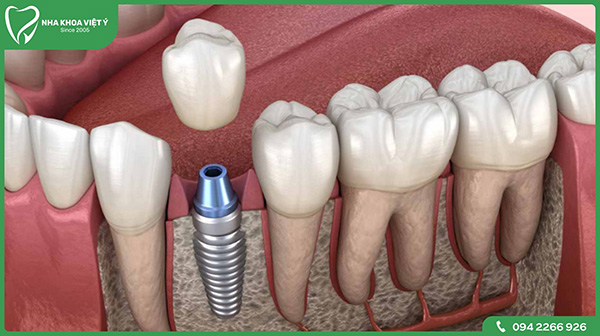 Kỹ thuật trồng răng Implant là gì?