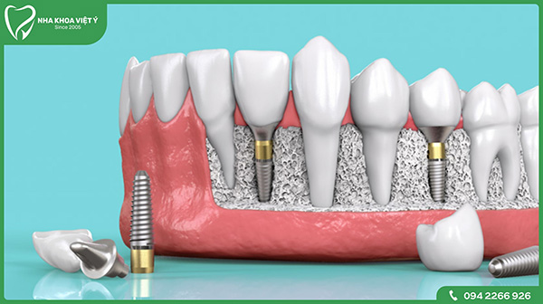 Vì sao nên lựa chọn trồng răng Implant