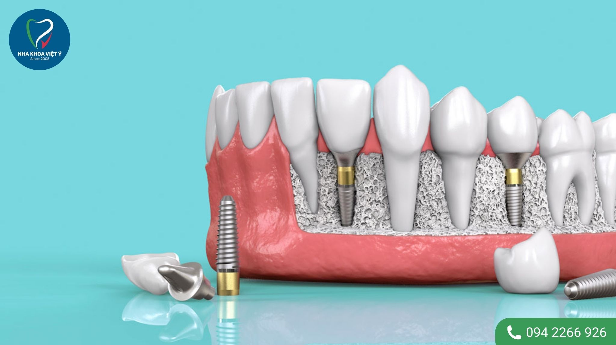 Trồng răng implant mất bao lâu?