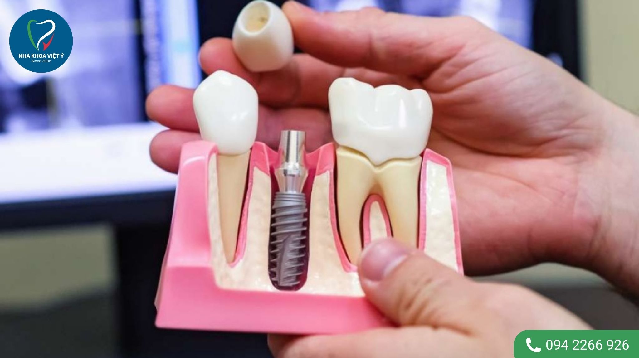 Ưu và nhược điểm trồng răng Implant