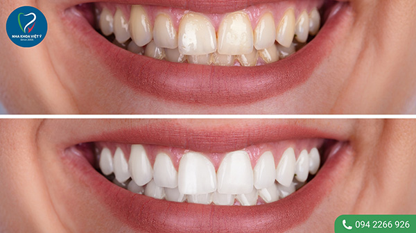 Tại sao nên tẩy trắng răng ố vàng?