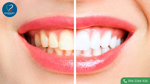Phương pháp tẩy trắng răng là gì?