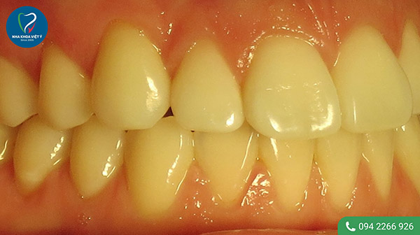Nguyên nhân khiến răng trám bị ố vàng?